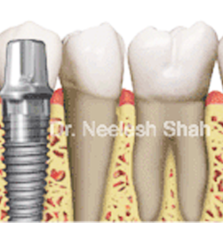 dental-implants